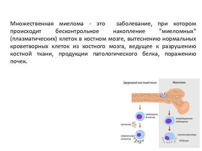 Множественная миелома картинки